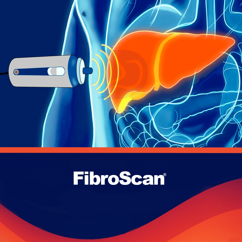 FibroScan - Evaluación no invasiva del hígado